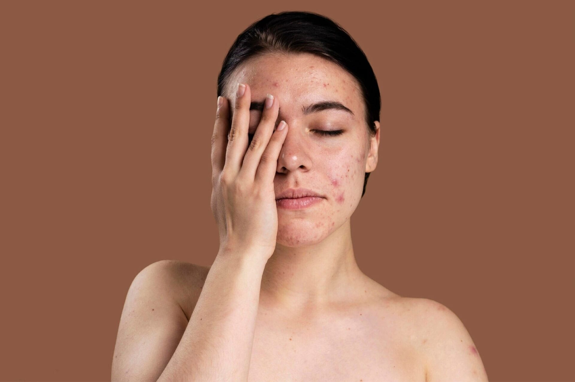 Ayuda a combatir el acné de manera natural con bardana 