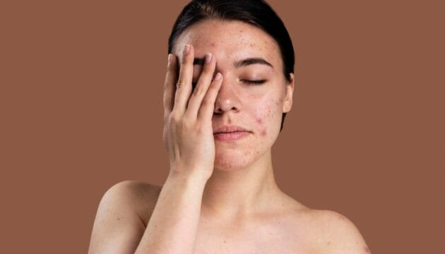 Ayuda a combatir el acné de manera natural con bardana 